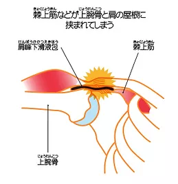 腱板損傷